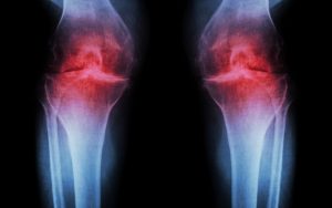 osteoarthritis and collagen peptides