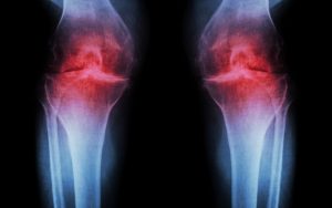 osteoarthritis and collagen peptides
