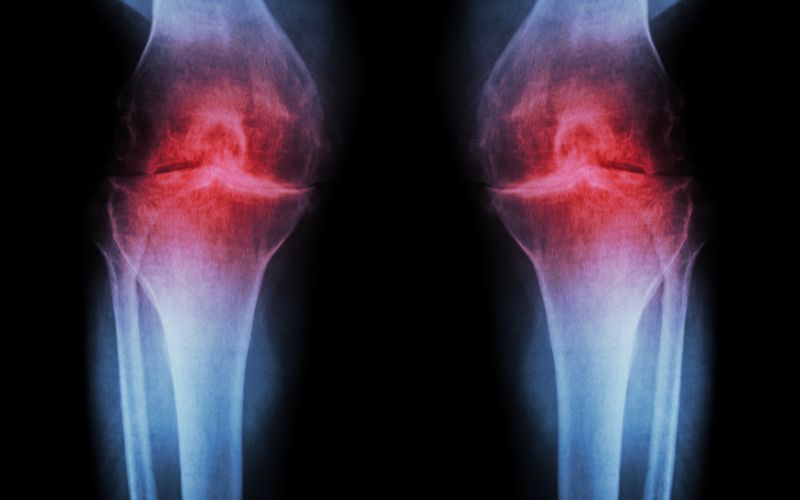 osteoarthritis and collagen peptides