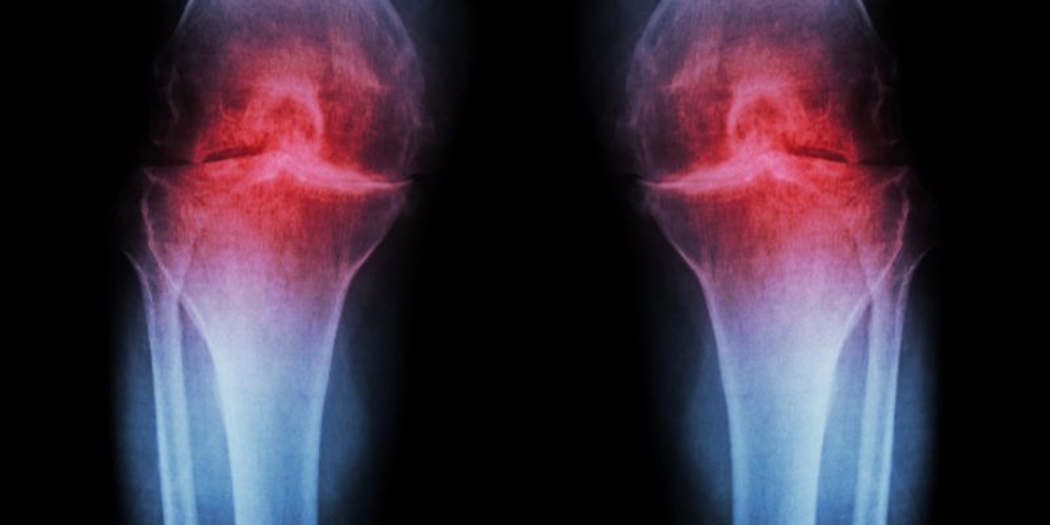 osteoarthritis and collagen peptides