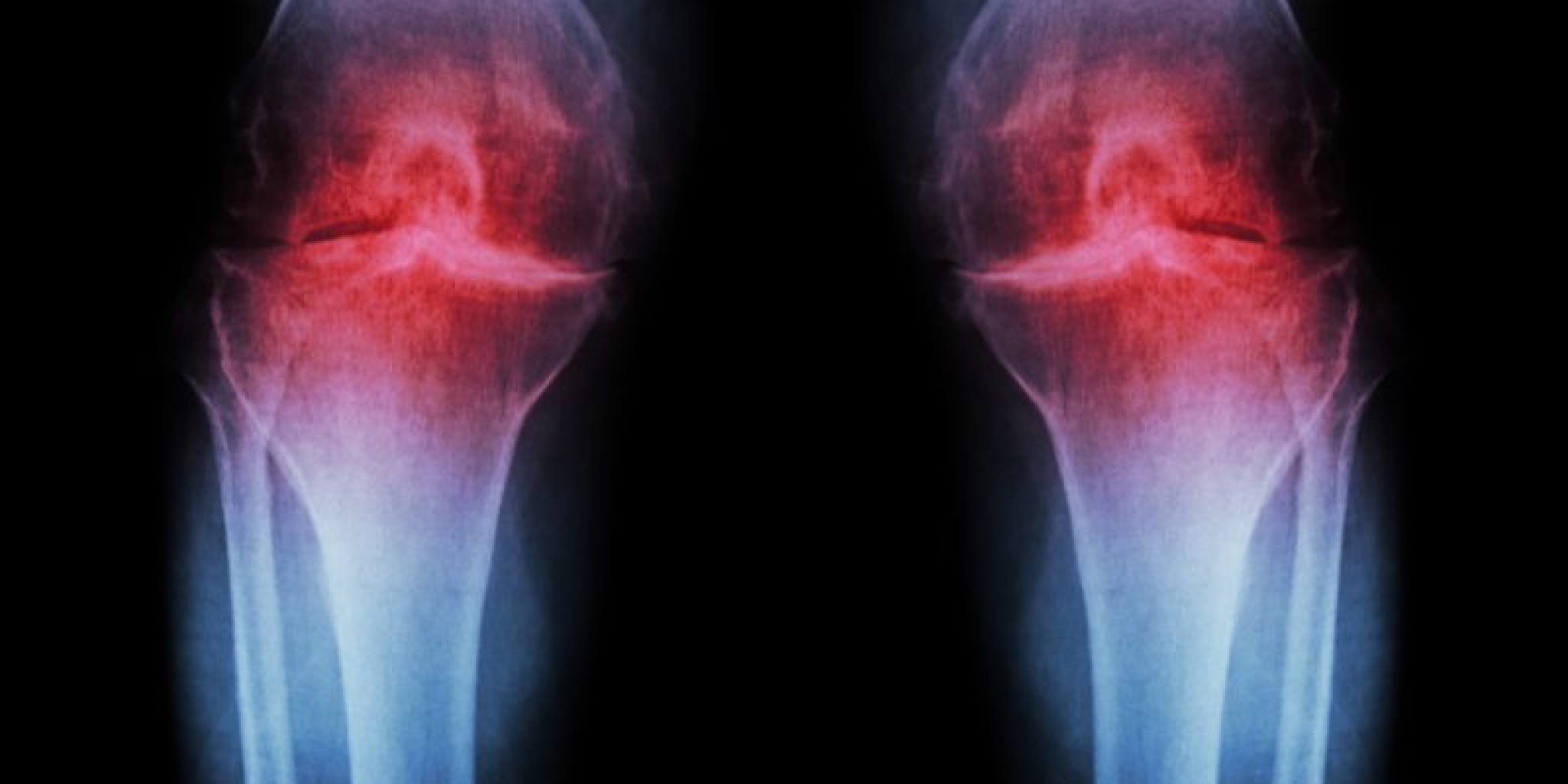 osteoarthritis and collagen peptides